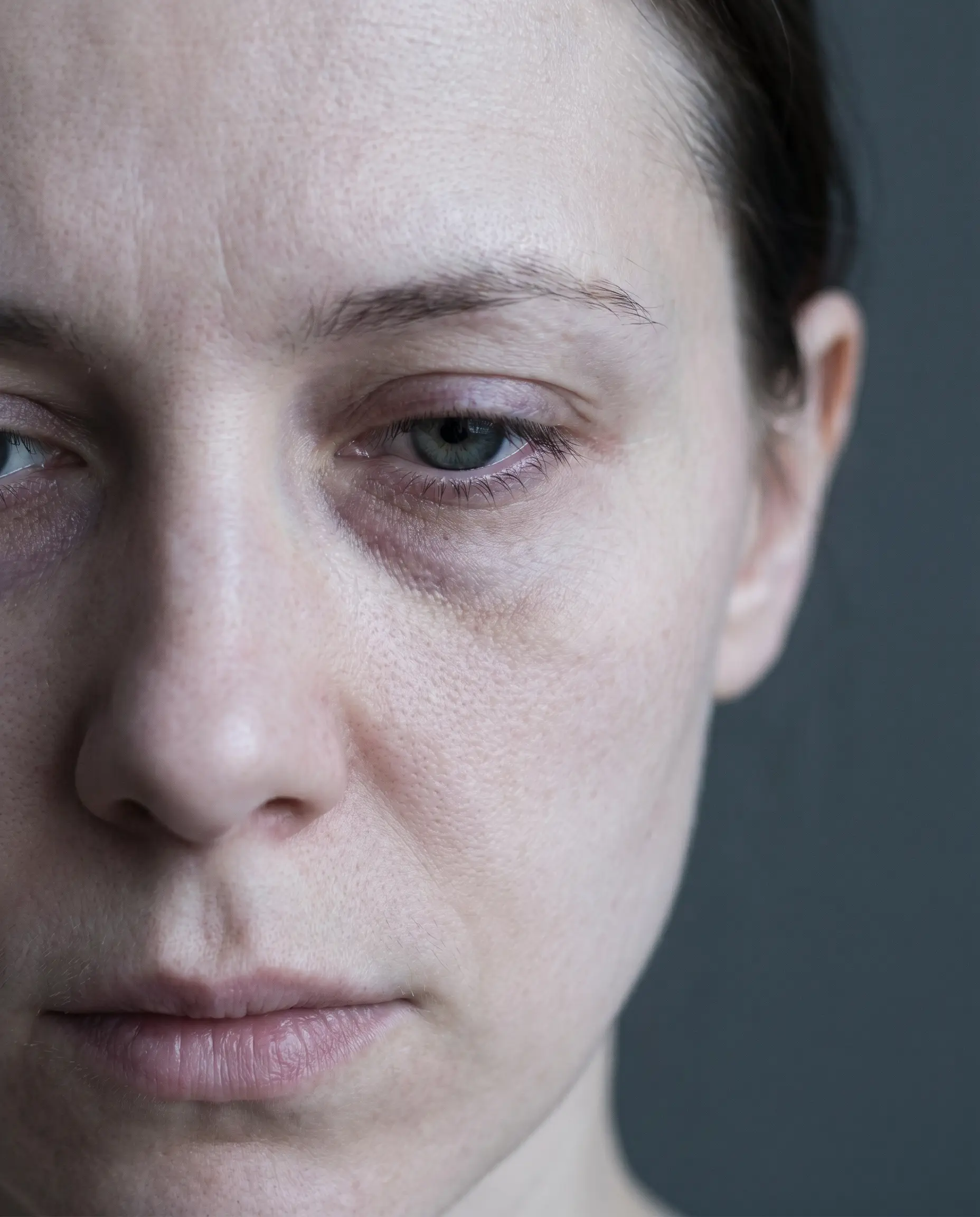 Close-up of under-eye area showing dark circles and mild puffiness